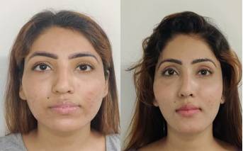 facelift surgery in india